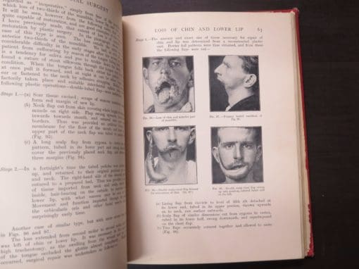 H. P. Pickerill (Surgeon-in-Charge of Facial And Jaw Department, Dunedin Hospital, Lieut.-Colonel NZMC) Facial Surgery, With An Introduction by W. Arbuthnot Lane - Image 5